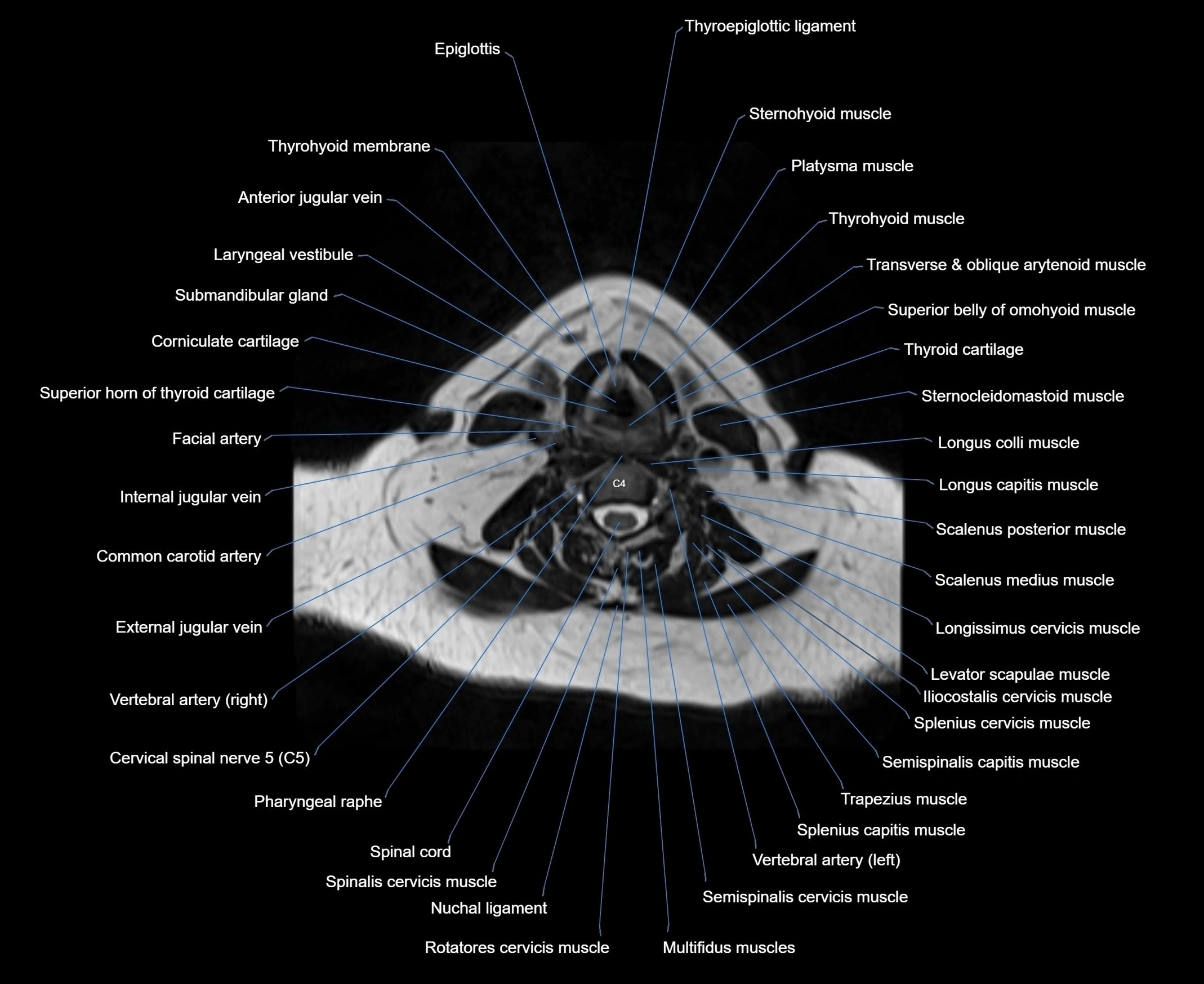 MRI Neck 3D labelled cross section anatomy axial 3t image-00001-00056.webp